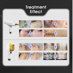 Diode Laser Machine Manufacturer - 2025 Professional 808 for Hair Removal