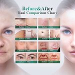 Microneedling Machine Manufacturer - Hottest Portable Micro Needling