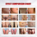 Body Slimming Machine Manufacturer - VELA SPRT SHAPES 200HZ Inner Ball Roller for Cellulite