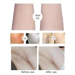 Laser Hair Removal Machine Manufacturer - Professional 808mn Diode Ice 810nm for Hair & Tattoo Removal