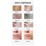 Butt Lift Enhancement Machine Manufacturer - Hot Sale Vacuum Suction Cup Breast Enlargement Device