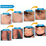 Micro Needle RF Hifu Device Manufacturer - 7d Hifu Face Body Care Anti-aging Beauty Device