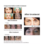 Dr Pen A6 Needle Cartridge Manufacturer - Micro Needle Replacement Cartridge for Microneedling Pen