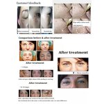 3 Handles Plasma Device - Facial Salon Wrinkle Removal Face Lifting Acne Removal Beauty Equipment