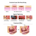 CO2 Fractional Laser Machine Manufacturer - 2025 Medical Home Use Aesthetic Acne Scar Treatment Beauty Equipment