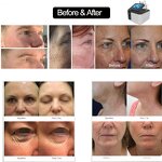 3 Handles Plasma Device - Facial Salon Wrinkle Removal Face Lifting Acne Removal Beauty Equipment