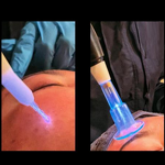 Plasma Therapy Machine - Wound Reduction 40% Bacteria Acne Allergies Dermatitis Eczema Wound Recovery Device