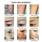 Picosecond Laser Machine Manufacturer - 532/1064nm All Color Pigment Freckle Removal Clinic Portable Beauty Equipment