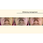 Plasma Therapy Machine - Wound Reduction 40% Bacteria Acne Allergies Dermatitis Eczema Wound Recovery Device