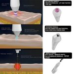 3 in 1 Plasma Machine - Facial Wrinkles Acne Scar Removal ABS Fractional Face Lifting Skin Tightening