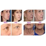 EMS Beauty Equipment Manufacturer - 30000 Shots V-Max Radar Line Carving Face Lifting Pigment Removal ABS UK Spa Device