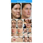 CO2 Fractional Laser Device Manufacturer - 2024 RF Tube 2000w Professional Skin Beauty Instrument