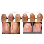 980nm Diode Laser Manufacturer - Nail Fungus Vascular Toenail Red Blood Filaments Removal Tool