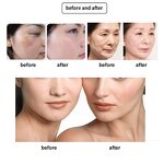 40.68mhz ThermoLift Device Manufacturer - Top Selling Face Lifting Wrinkle Removal Monopolar Rf Beauty Tool