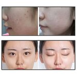 2in1 EMS Nano RF Mesotherapy Machine Manufacturer - No Needle Oxygen Injector Mesogun Moisture Skin Rejuvenation Tool