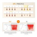 DPL IPL Laser Beauty Machine Manufacturer - New 640/690nm Hair Removal Skin Rejuvenation Face Body Leg Tool