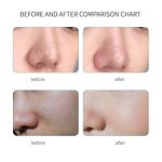 7 in 1 Micro Bubble Hydrodermabrasion Manufacturer - Best Selling Aqua Peel Hydra Whitening Salon Spa Beauty Tool