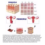 10600 Nm Co2 Fractional Laser Manufacturer - 60w RF Tube Warts Scars Birthmarks Removal Beauty Machine Tool