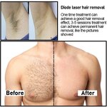 Vertical Diode Laser Hair Removal Machine Manufacturer - 755/808/1064nm High Power Changeable Spot Size Tool