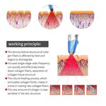 Excilift Ultra360 RF Machine Manufacturer - Factory Price Eye Bag Removal Monopolar Rf Skin Tightening Tool