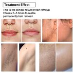 3 Wavelength Nd Yag Laser Manufacturer - 2025 810/808/1064nm 800w 1800w Diode Hair Removal Machine