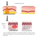 448khz Monopolar RF Machine Manufacturer - Weight Loss Skin Tightening Face Lift Standing Head IT ZA CN Tool