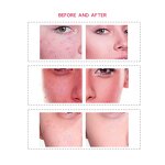 PDT Led Lighting Therapy Machine Manufacturer - New Acne Skin Body Treatment Red Light Facial Beauty PDT Tool