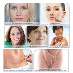 60w Fractional Co2 Laser Machine Manufacturer - New Stretch Mark Treatment Scar Removal Face Lifting Beauty Tool