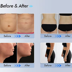 Cryotherapy Machine Manufacturer - Portable Criolipolisis Fat Freezing Vacuum with Oxygen Jet