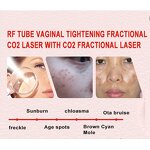 CO2 Laser Machine Manufacturer - Portable Diode for Vaginal Tightening Skin Resurfacing