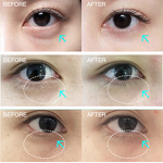 360 Collagen Gun - Beauty Equipment Face Lifting Eye Wrinkle Reduction