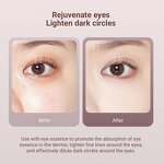 Eye Massage Instrument Manufacturer - Galvanic Anti-aging Wrinkle Removal & Lifting