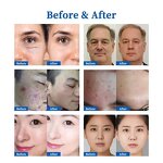 Salon-Grade Microcurrent Machine - LED Face Hand Wrinkle Acne Removal US/IT/ZA