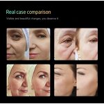 25D Hiifu Device - Newest 360 Degree 3 In 1 Skin Tightening Wrinkle Removal Care