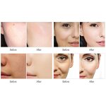 No Needle Mesotherapy - Portable High Pressure Injection Gun Face Moisture Care