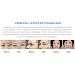 RF Skin Rejuvenation Machine - 2024 3 in 1 Tips Face Eyes Lifting Device