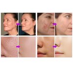 Gold Hydra Roller - Face 64 Pins with Glass Bottle Wrinkle Removal Injection