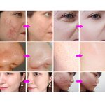 14 in 1 Hydra Machine - Vertical Professional RF Skin Whitening Acne Removal