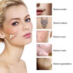 Laser Mole Removal Pen - Point Mole Pen Home Use Beauty Removal Machine