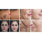Picosecond Laser Machine - Carbon Peeling Tattoo Pigment Removal with 3 Heads