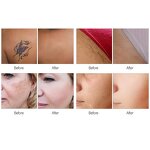 2 in 1 Pico Laser Machine - 2024 New Portable 808nm 1064nm 755nm Hair Removal