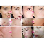 Nano Derma Pen - Electric Microneedling 6 Speed Painless Agujas Device