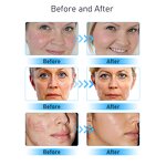 6 in 1 Micro Dermabrasion - Hot Sell Hydrodermabrasion RF Aqua Peel Skin Scrubber