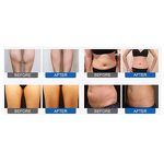 Pressotherapy Suit Machine - Detox Body Belly Leg Fat Reduce Warm Slimming