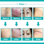 Hair Removal Equipment Manufacturer - Portable Professional OPT Skin Rejuvenation