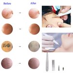 Cautery Machine Manufacturer - Professional for Wart & Black Spot Removal Portable