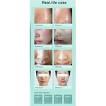 Hydrodermabrasion Machine Manufacturer - AU-S501 Salon Use 6 in 1 360° Visual