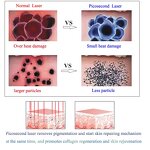 Picosecond Laser Machine Manufacturer - Professional Super for Tattoos