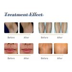 Diode Laser Hair Removal Machine Manufacturer - Professional 808nm with Super Cooling