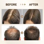 Derma Stamp Manufacturer - Bio 4 Customizable for Acne Treatment Titanium